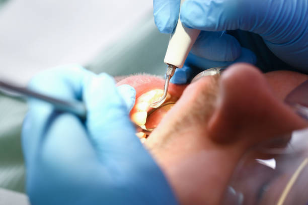 Best Emergency Root Canal Treatment in Enterprise, WV