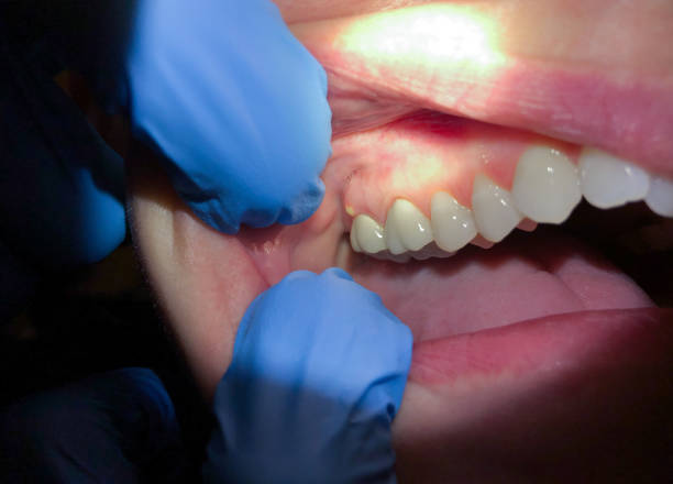 Best Emergency Dental Care for Broken or Chipped Teeth in Enterprise, WV